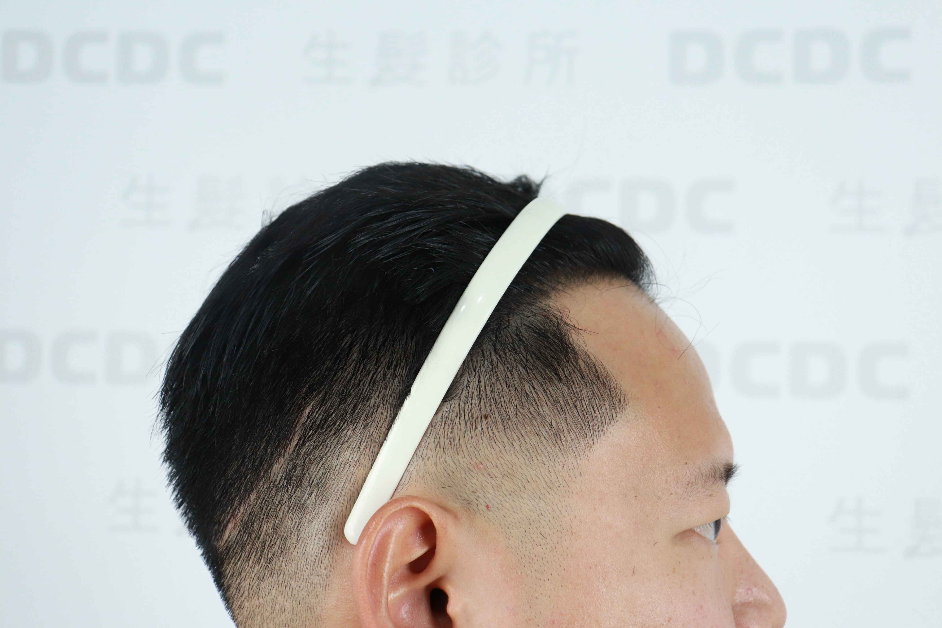 DCDC生髮診所-M型額角完全填補高密度毛流術後一年側顏效果